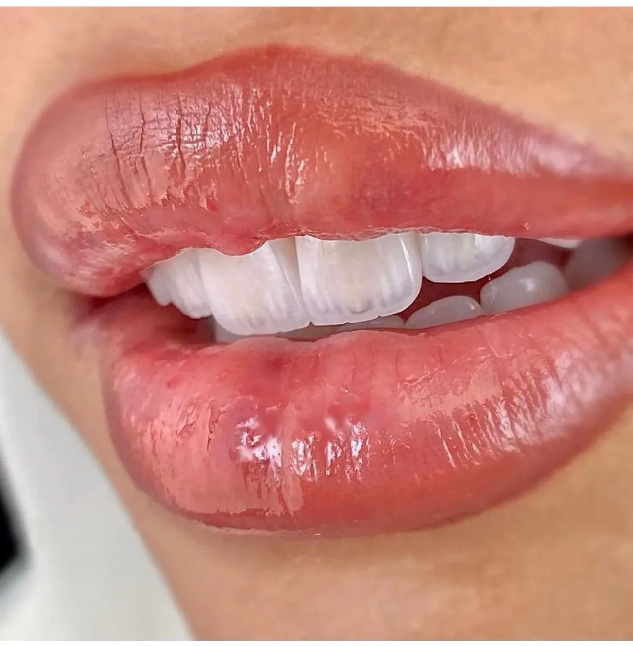 Temel Dental estetik diş uygulaması örneği