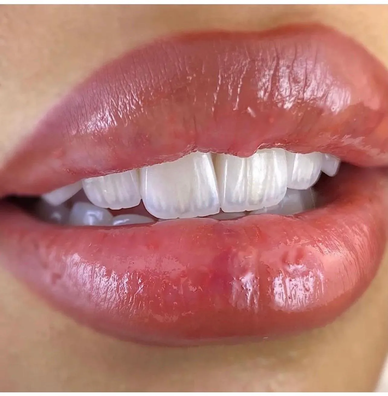 Temel Dental estetik diş tedavisi uygulama örneği