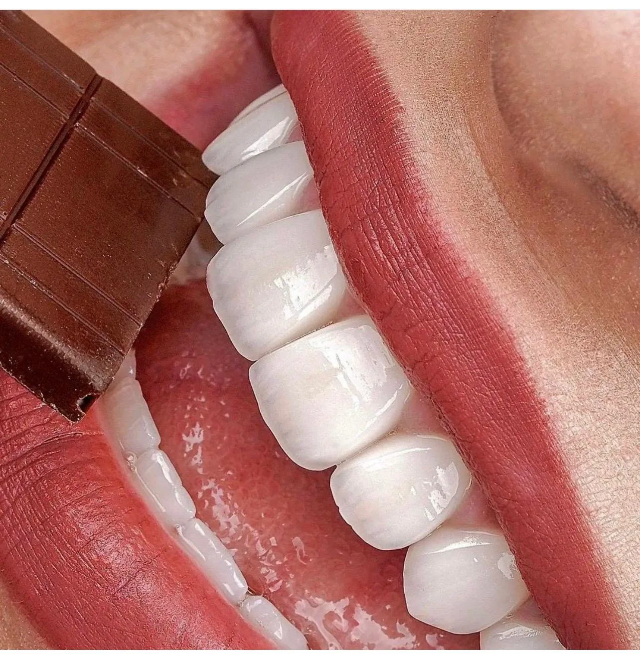 Temel Dental dental estetik uygulama detayı